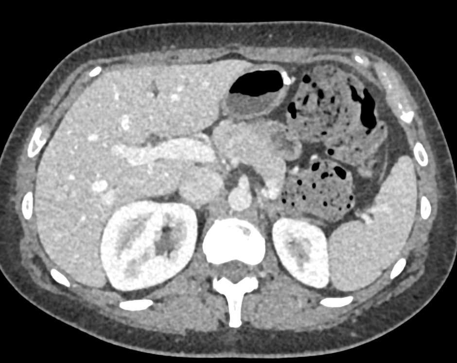 Clear Cell Renal Cell Carcinoma Right Kidney - CTisus CT Scan