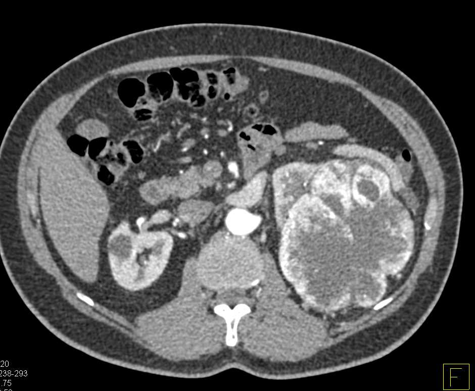 Clear Cell Renal Cell Carcinoma (ccRCC) with Neovascularity Left Kidney - CTisus CT Scan