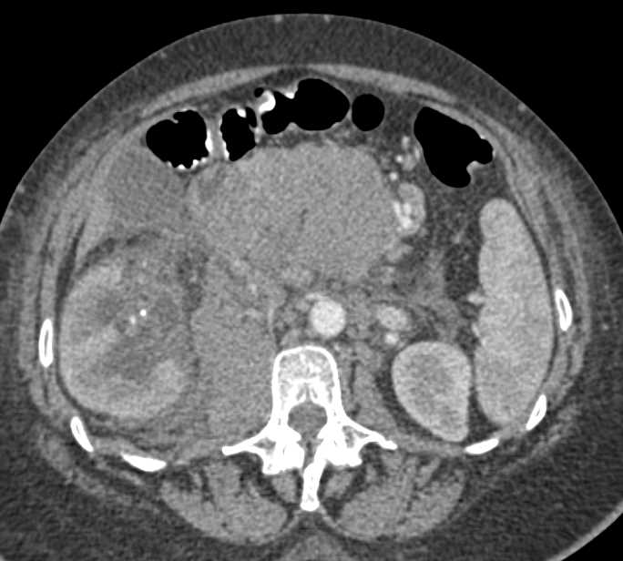 Lymphoma with Extensive Adenopathy in Mesentery and Extension to Involve the Right Kidney - CTisus CT Scan