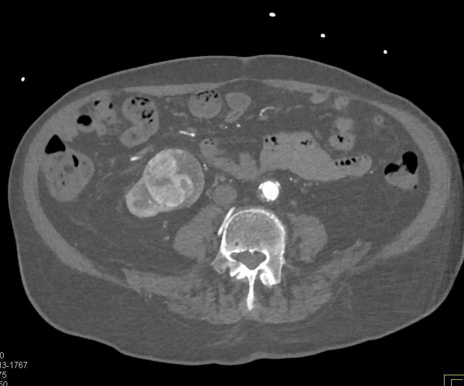 Clear Cell Renal Cell Carcinoma Right Kidney - CTisus CT Scan