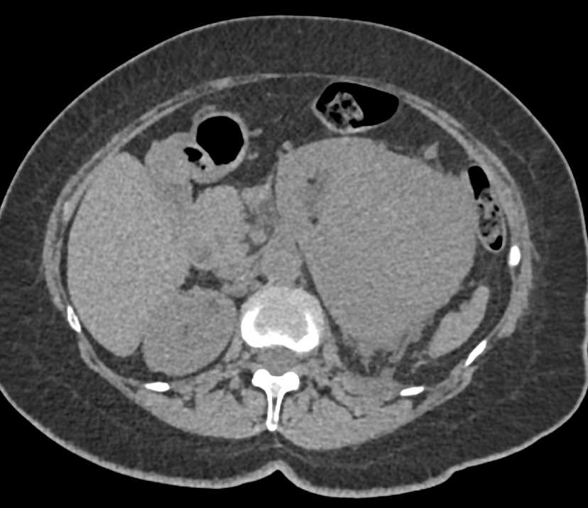 Clear Cell Renal Cell Carcinoma (ccRCC) with Neovascularity Left Kidney - CTisus CT Scan