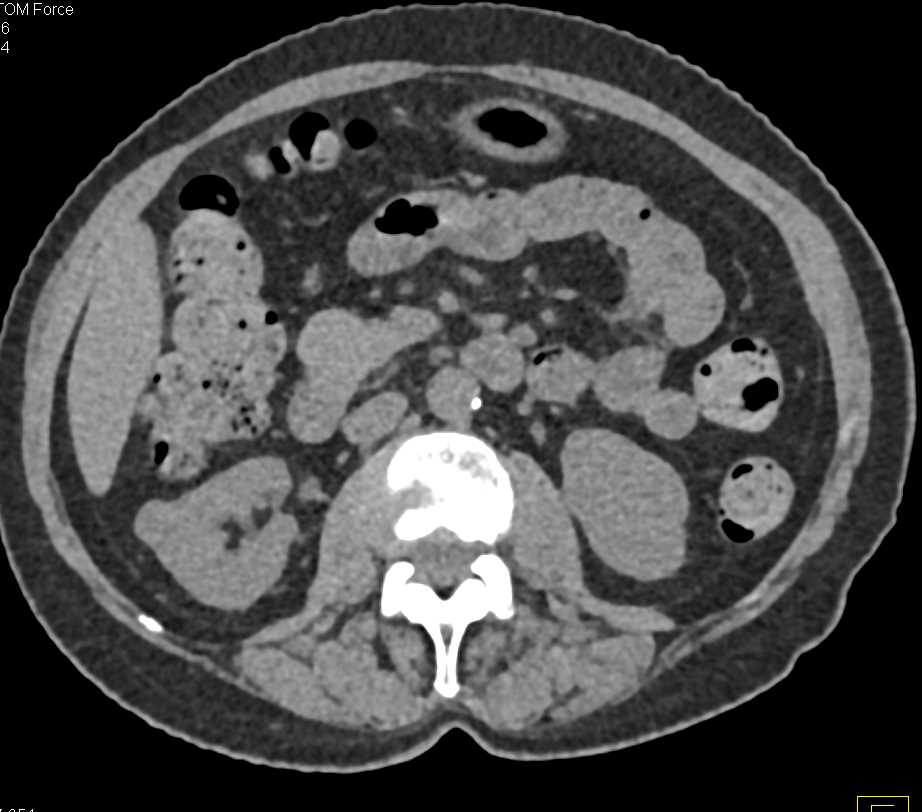 Complex Cyst Right Kidney Simulates a Tumor - CTisus CT Scan