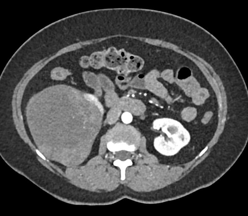 Cystic Right Renal Cell Carcinoma - CTisus CT Scan