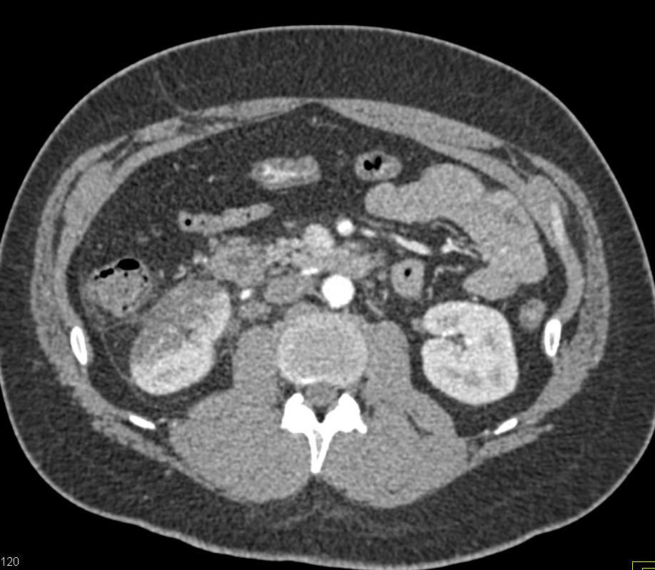 Segmental Infarction Right Kidney - CTisus CT Scan
