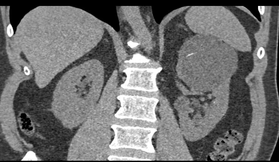 Bosniak 2F Cysts Left Kidney - CTisus CT Scan