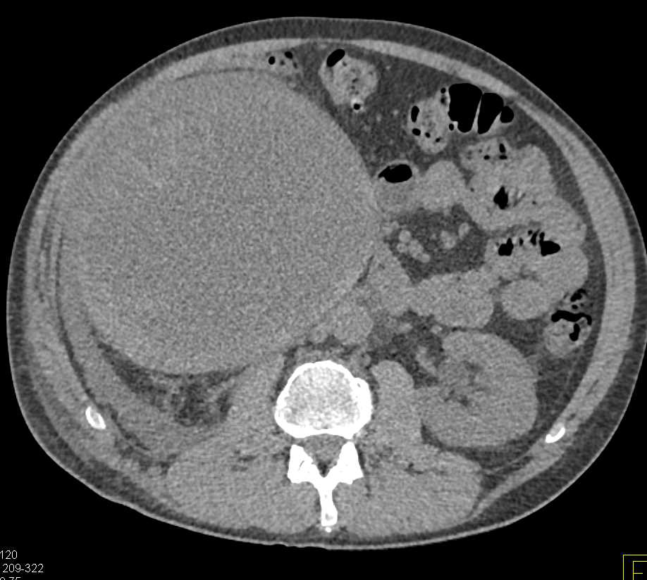 Cystic Clear Cell Renal Cell Carcinoma - CTisus CT Scan