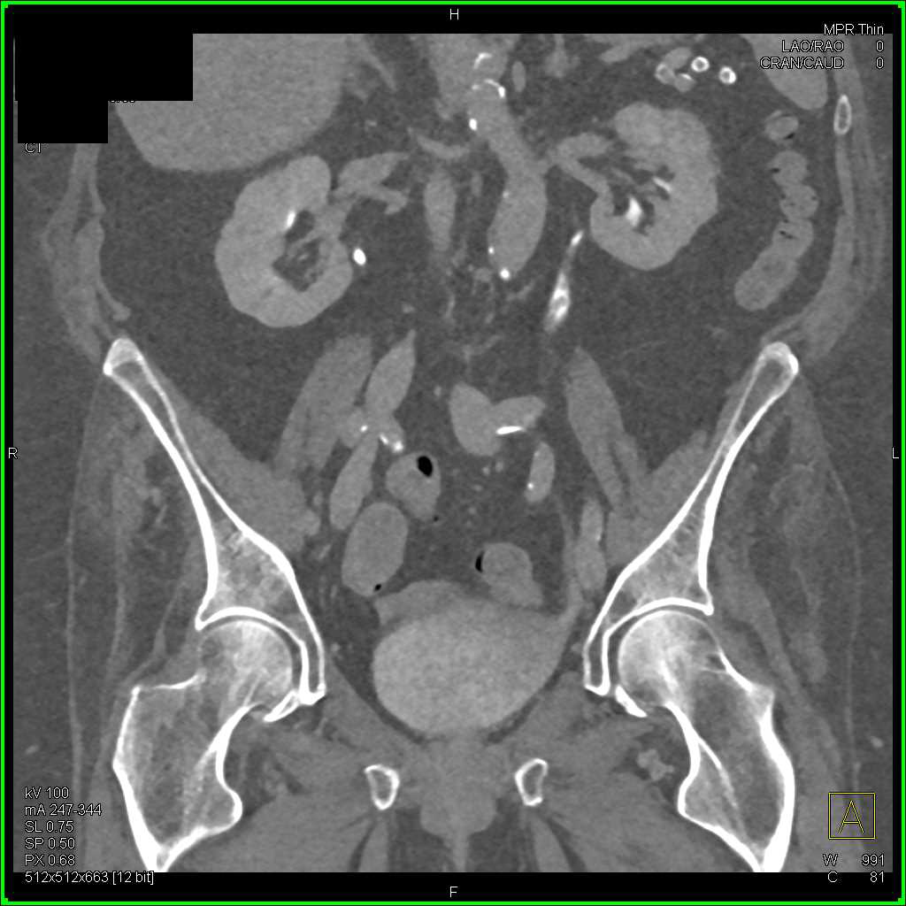 Transitional Cell Carcinoma Left Ureter - CTisus CT Scan