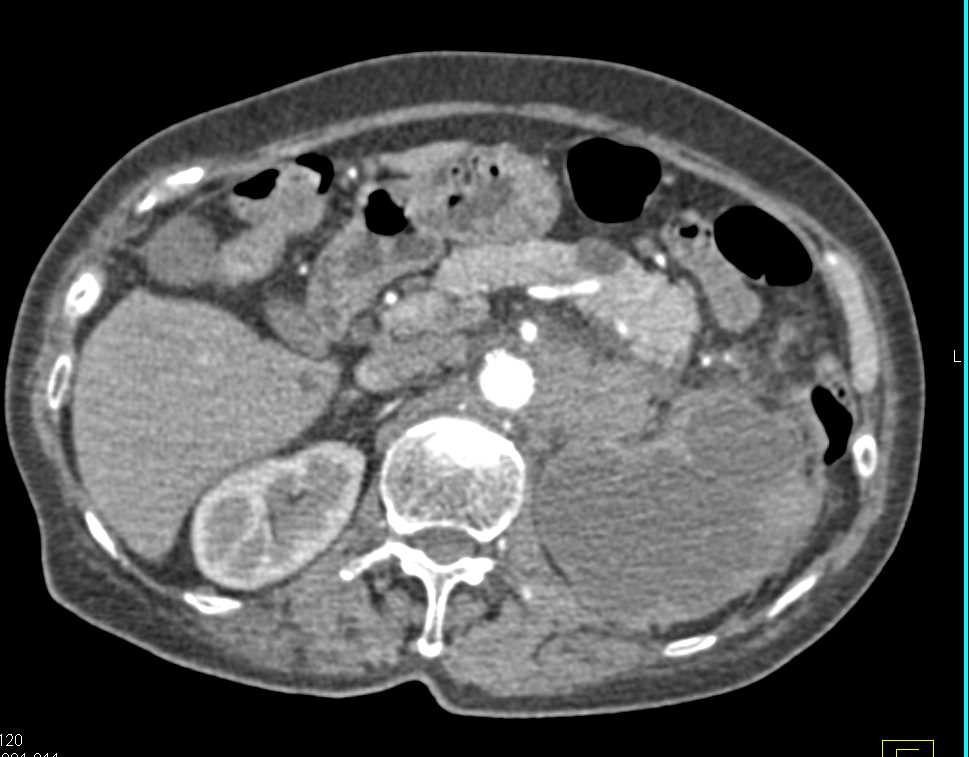 Multi-focal Transitional Cell Carcinoma with Extensive Adenopathy - CTisus CT Scan