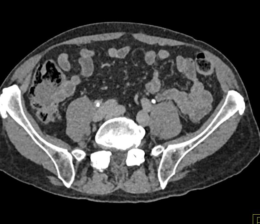 Transitional Cell Carcinoma (TCC) Right Ureter - CTisus CT Scan