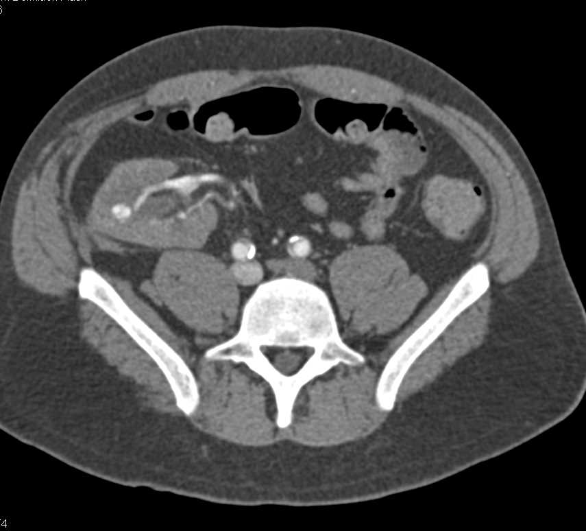 Right Renal Transplant with Vascular Shunting - CTisus CT Scan