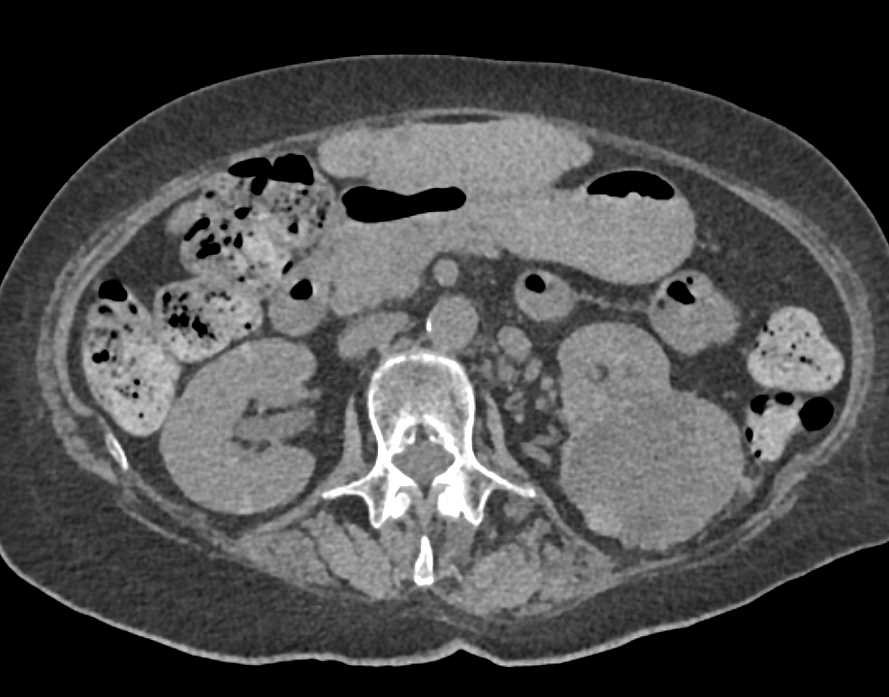 Clear Cell Renal Cell Carcinoma (ccRCC) with Bone Metastases - CTisus CT Scan