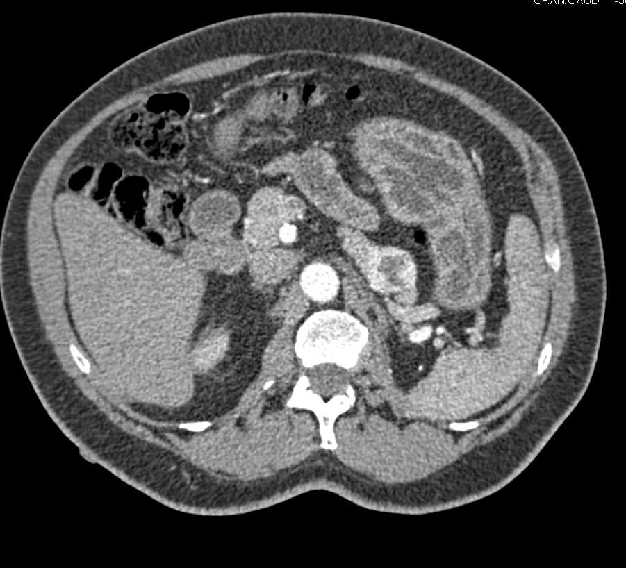 Recurrent Renal Cell Carcinoma (RCC) with Pancreas and Bone Metastases - CTisus CT Scan