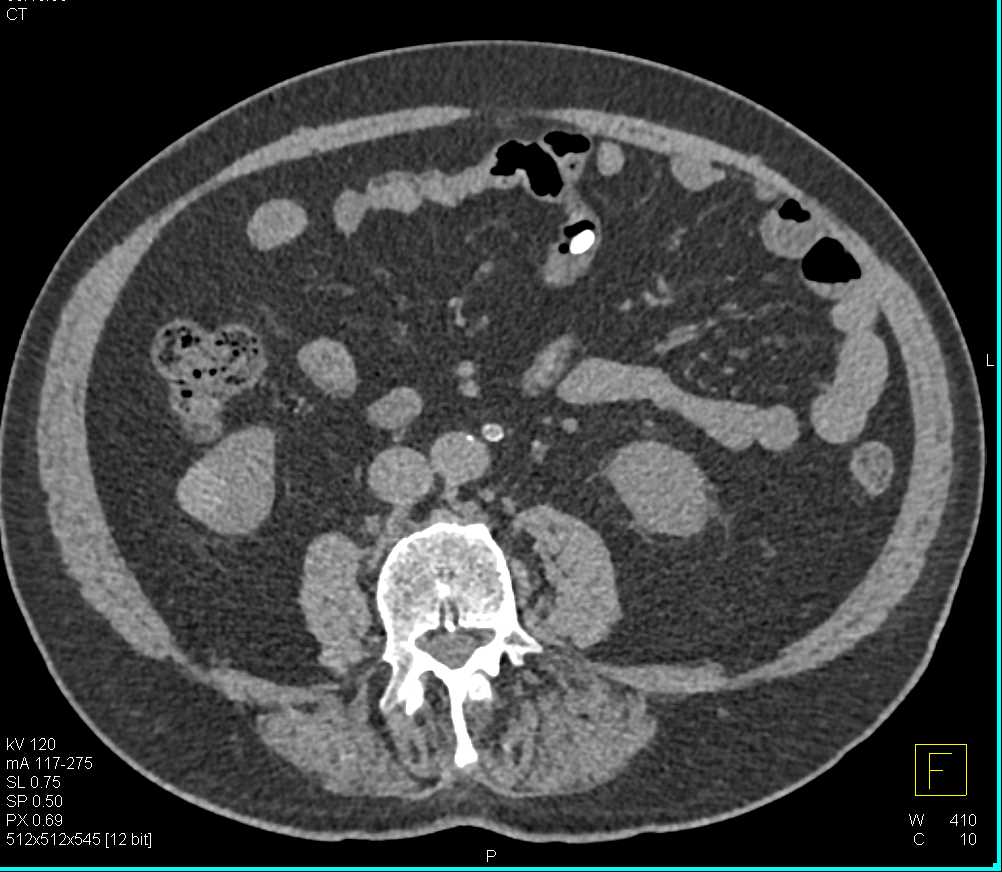 High Density Cyst Right Kidney Simulates a Solid Mass on Imaging - CTisus CT Scan