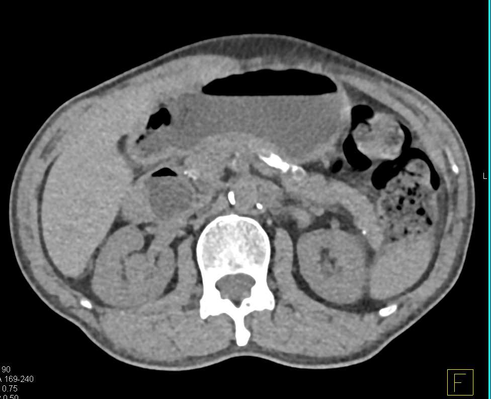 Transitional Cell Carcinoma Upper Pole Calyces Right Kidney in Multiple Phases - CTisus CT Scan