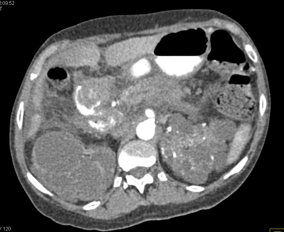 Polycystic Kidney Disease - CTisus CT Scan