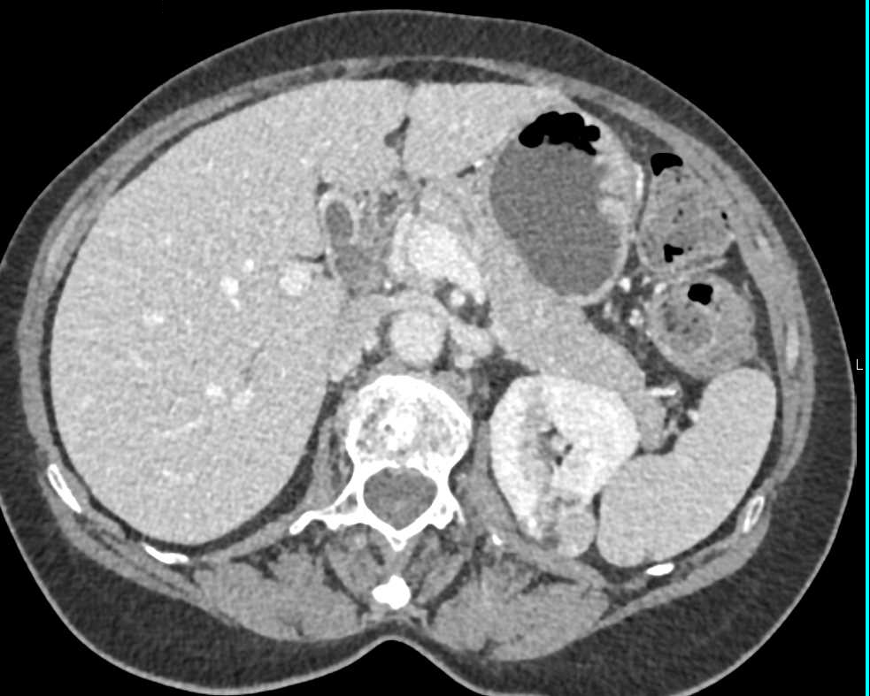 Angiomyolipoma (AML) Upper Pole Left Kidney - CTisus CT Scan