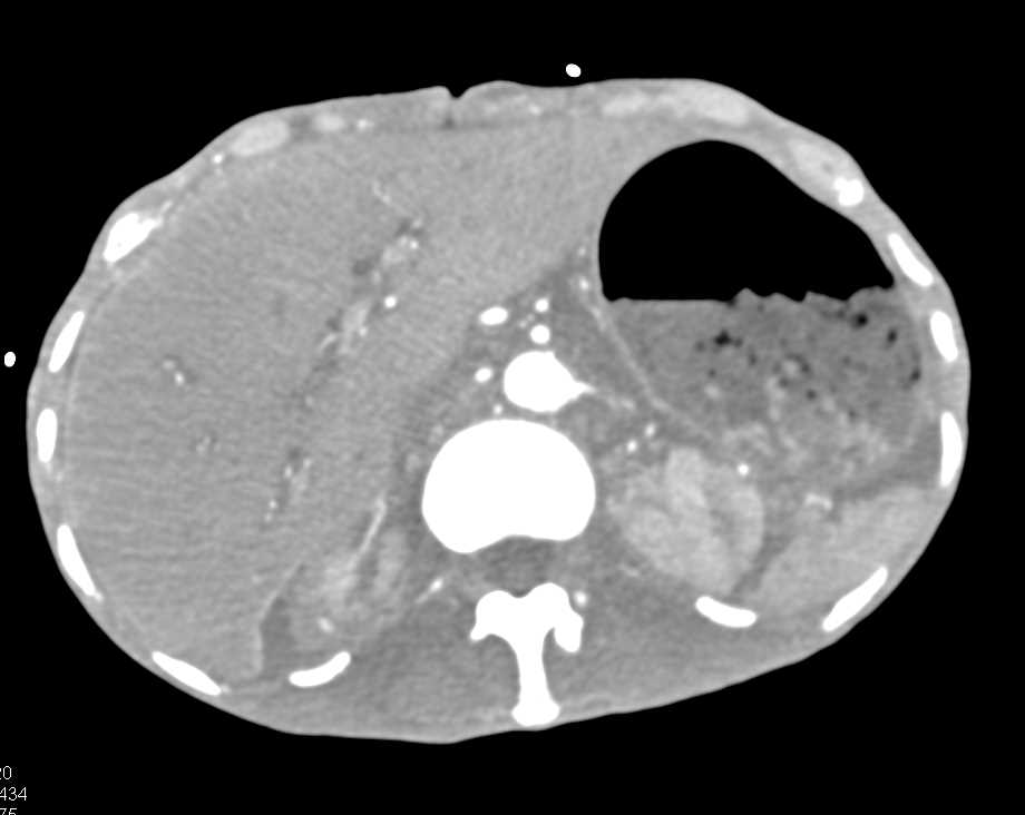 Hypotensive Patient with Renal Infarction - CTisus CT Scan