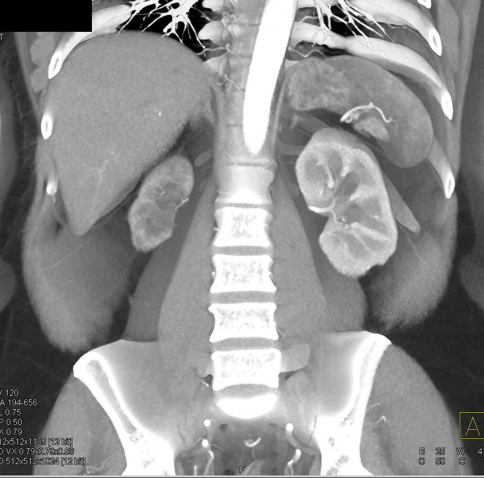 Chronic Pyelonephritis - CTisus CT Scan