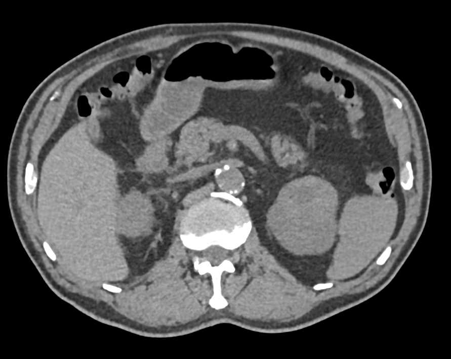 Bilateral Renal Cell Carcinoma - CTisus CT Scan