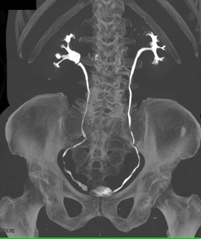 Multiple Calculi in the Distal Right Ureter - Kidney Case Studies