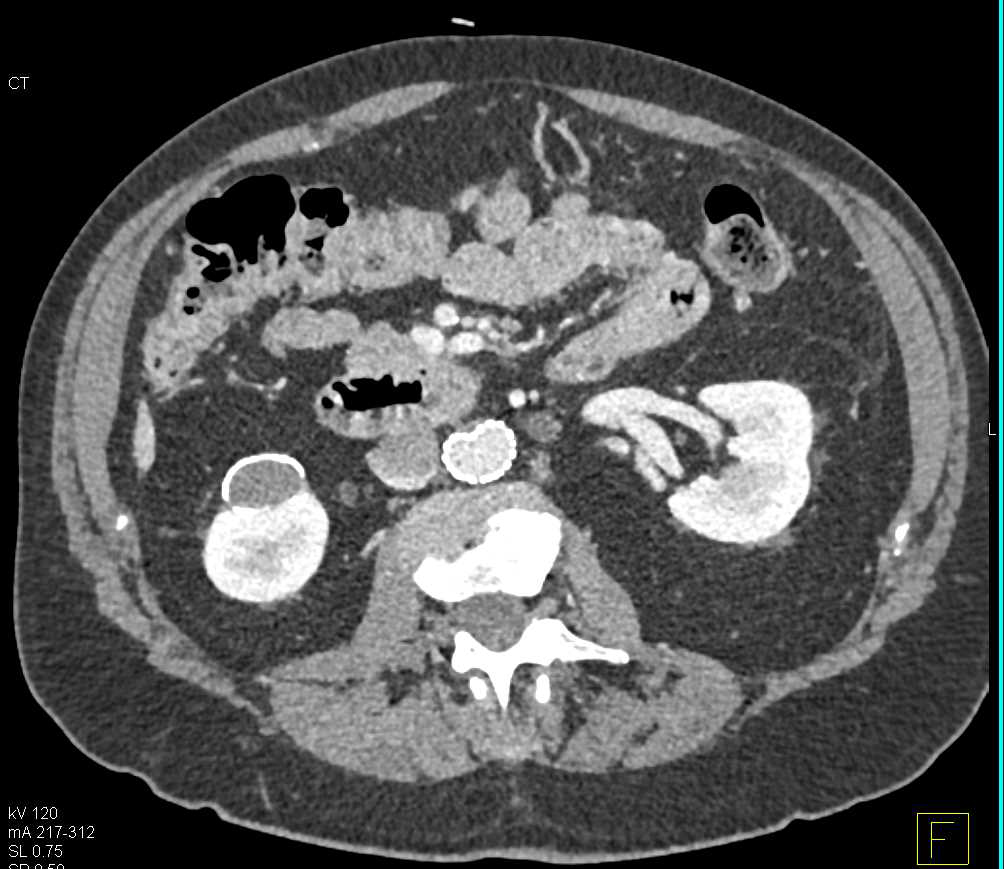 Calcified Old Hematoma Right Kidney - CTisus CT Scan