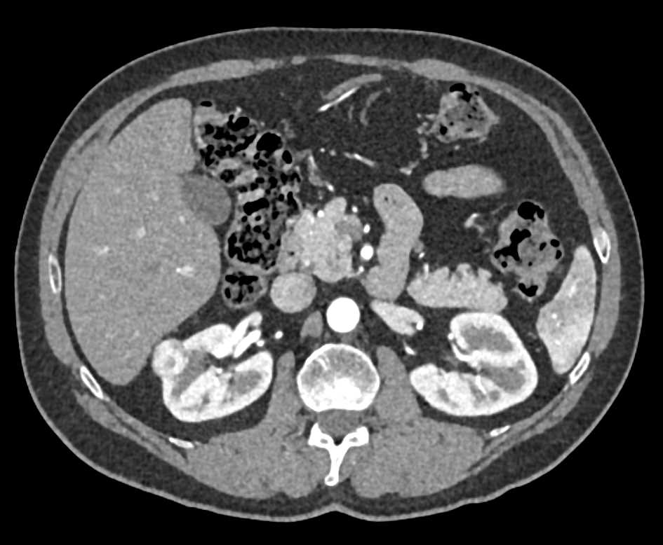 2cm Right Renal Cell Clear Cell Carcinoma - CTisus CT Scan