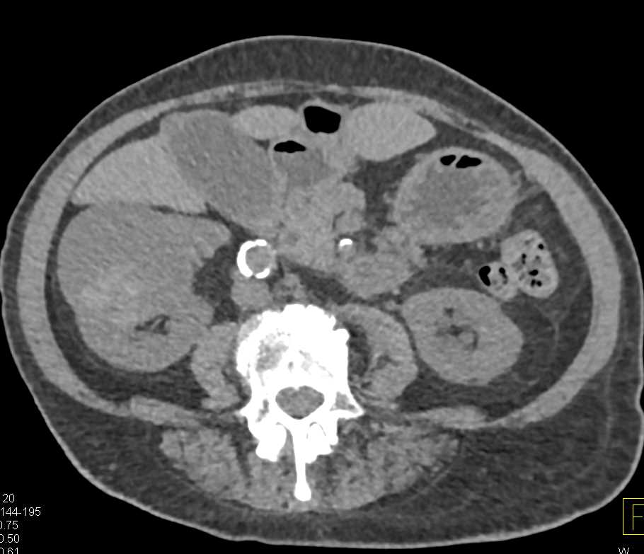 Hemorrhagic Cyst Right Kidney - CTisus CT Scan