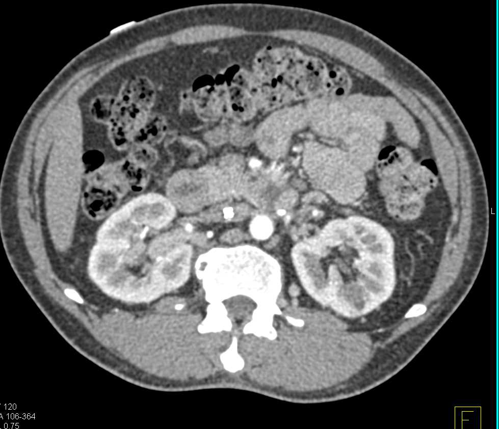 Transitional Cell Carcinoma (TCC) Right Kidney - CTisus CT Scan