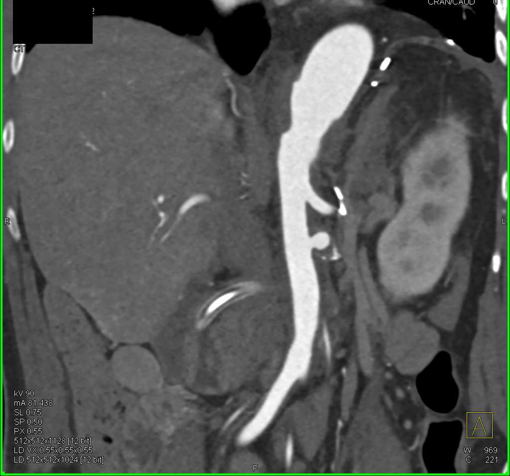 Infarcted Right Kidney - CTisus CT Scan