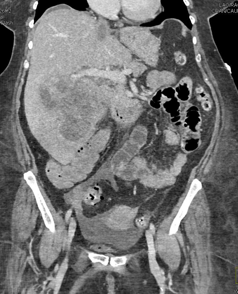 Renal Cell Carcinoma with Bone Metastases and Liver Metastases - CTisus CT Scan