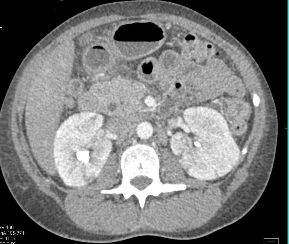 Focal Pyelonephritis - CTisus CT Scan