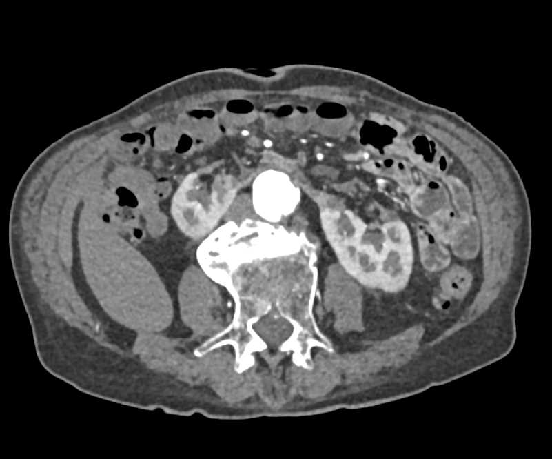 Horseshoe Kidneys with Infarcts - CTisus CT Scan