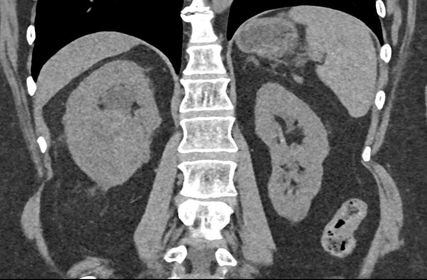 Papillary Renal Cell Carcinoma Right Kidney - CTisus CT Scan