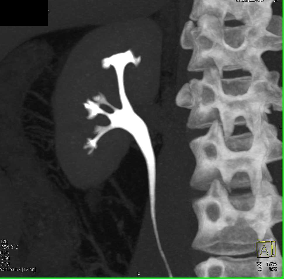 Classic Papillary Necrosis Right Kidney - CTisus CT Scan