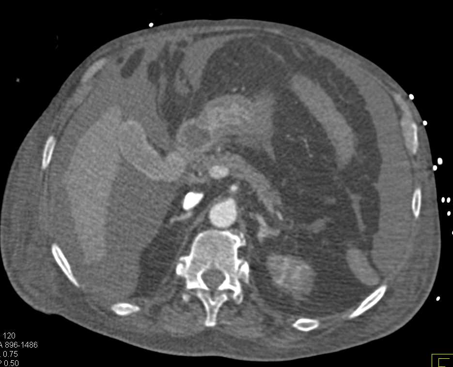 End Stage Renal Disease (ESRD) and Hemoperitoneum - CTisus CT Scan