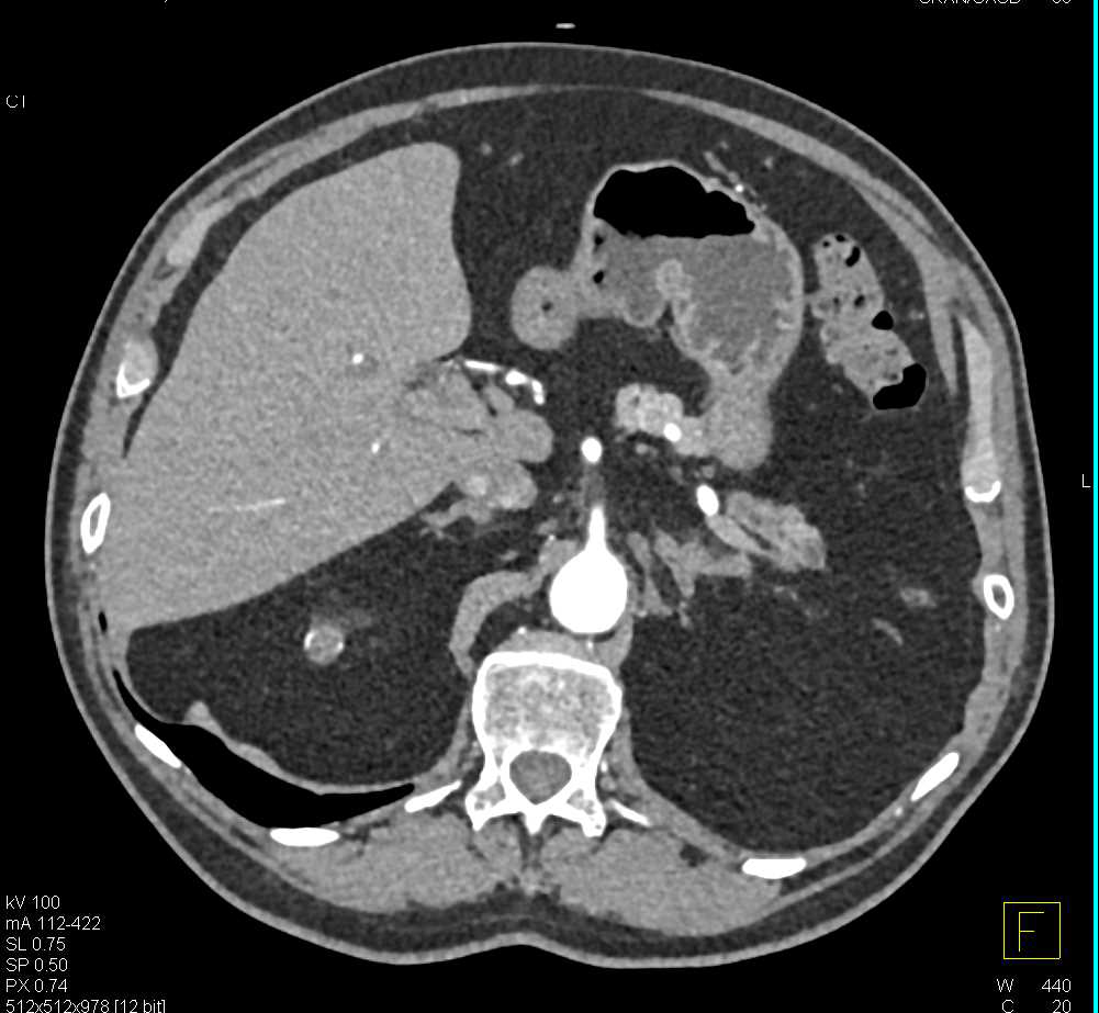 Incidental Right Renal Cell Carcinoma - CTisus CT Scan