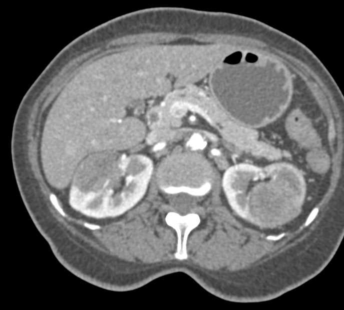 Renal Cell Carcinoma with Lung Metastases - CTisus CT Scan