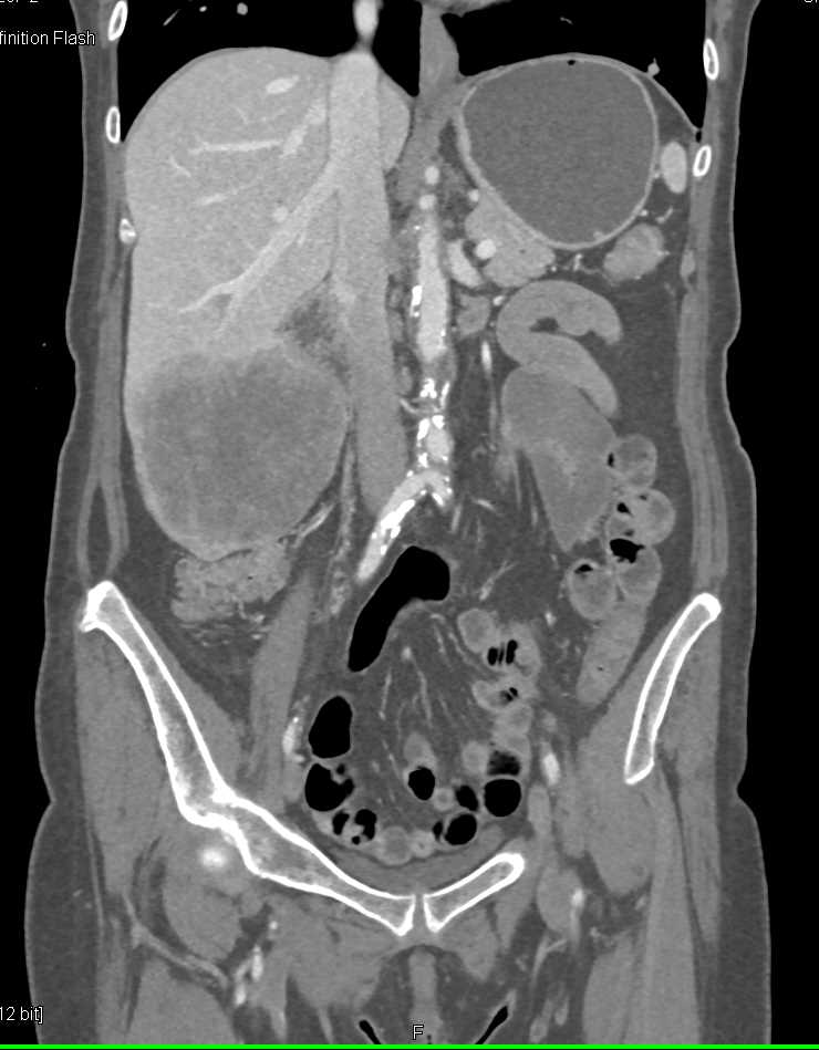 Renal Cell Carcinoma with Lung Metastases and Liver Metastases - CTisus CT Scan