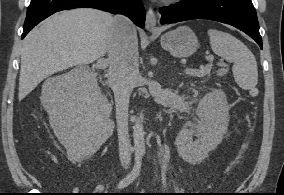 Left Renal Cell Carcinoma Invades the Renal Vein and Inferior Vena Cava (IVC) - CTisus CT Scan