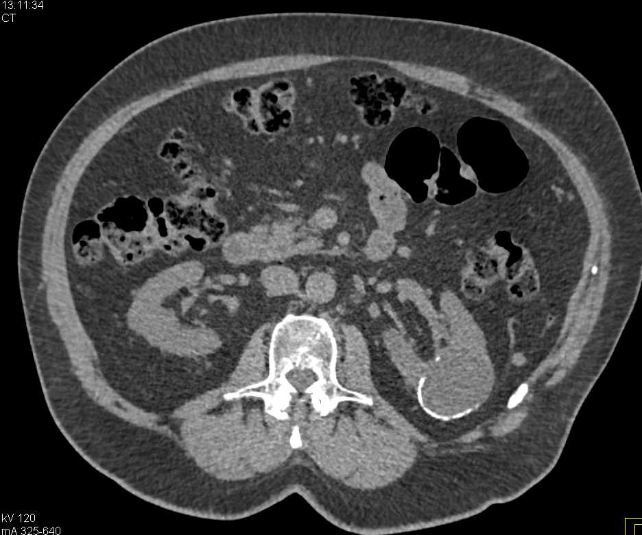 1cm Renal Cell Carcinoma (RCC) and Calcified Left Renal Cyst - CTisus CT Scan