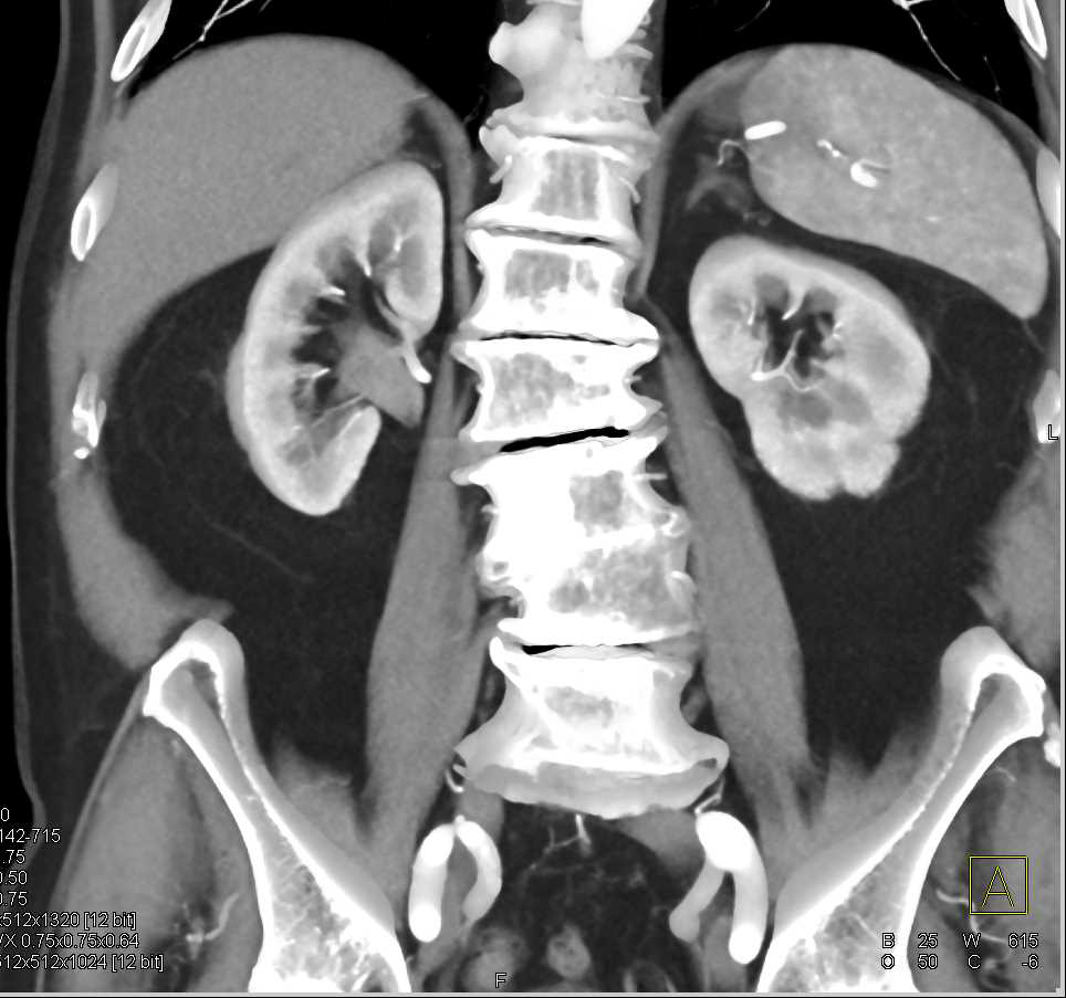 Transitional Carcinoma Right Kidney - CTisus CT Scan