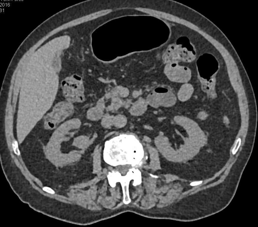 Transitional Carcinoma Right Kidney - CTisus CT Scan