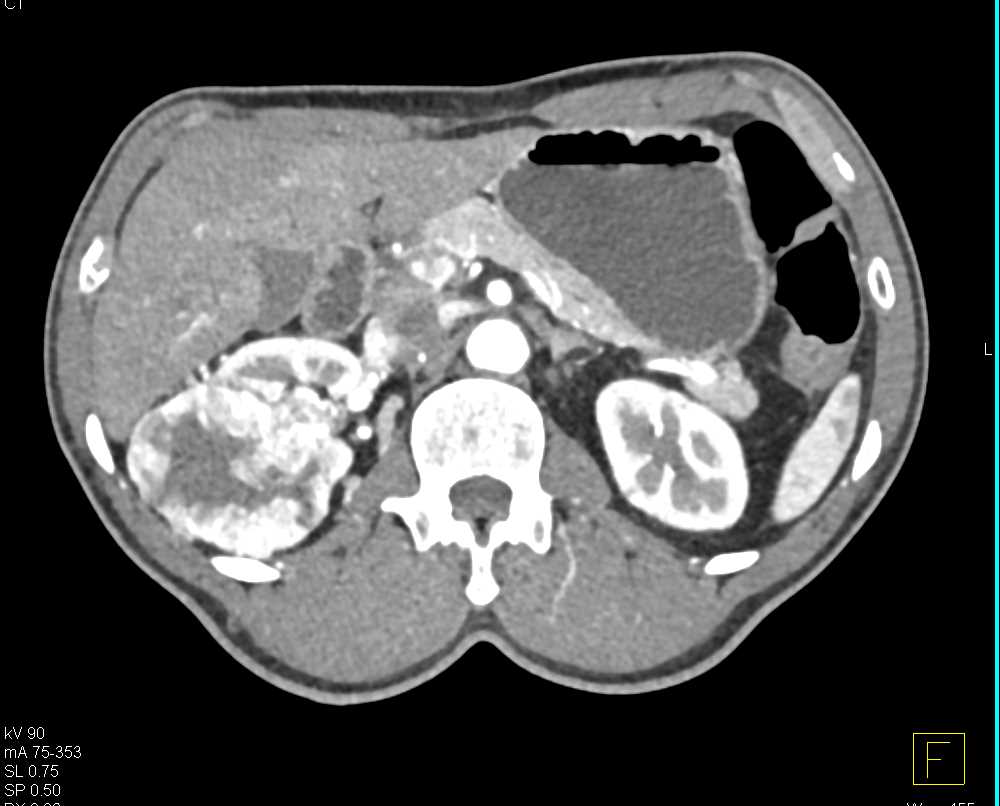 Clear Cell Renal Cell Carcinoma (CCRCC) Right Kidney - CTisus CT Scan