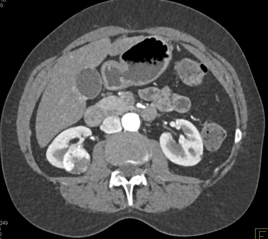 Clear Cell Renal Cell Carcinoma (CCRCC) Simulates an Oncocytoma - CTisus CT Scan