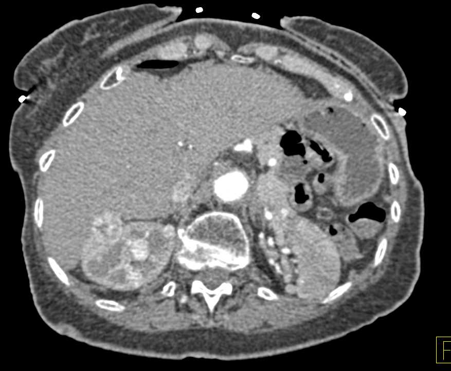 Renal Cell Carcinoma with Lung Metastases and Contralateral Kidney Metastases - CTisus CT Scan