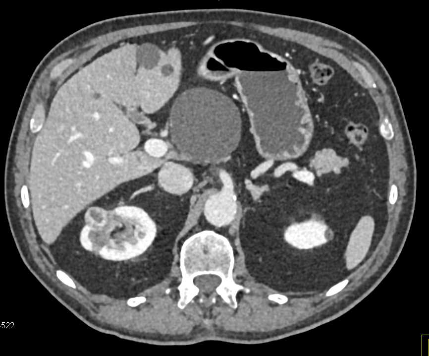Renal Cell Carcinoma with Metastases - CTisus CT Scan