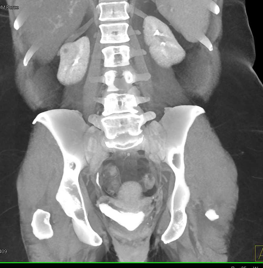 Cystic Right Renal Cell Carcinoma - CTisus CT Scan