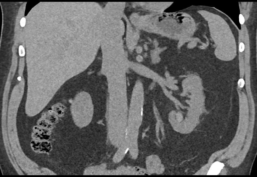 Transitional Cell carcinoma Lower Pole Calyx Left Kidney - CTisus CT Scan