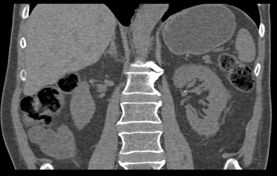 Renal Cell Carcinoma with Bone Metastases - CTisus CT Scan