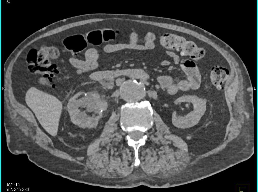 Transitional Cell Carcinoma (TCC) Right Renal Pelvis - CTisus CT Scan